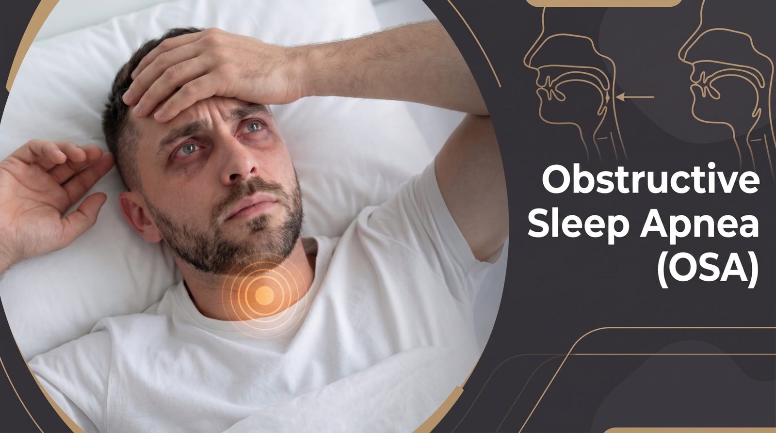 Obstructive Sleep Apnea (OSA) — 32 Dental & TMJ Solutions